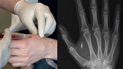 injectable rfid chip|Everything You Need To Know Before Getting An RFID Implant.